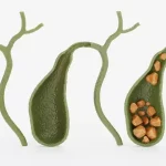 Чому в жовчному міхурі утворюються камені