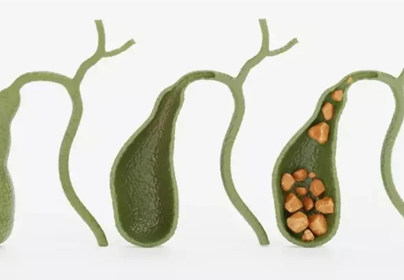 Чому в жовчному міхурі утворюються камені