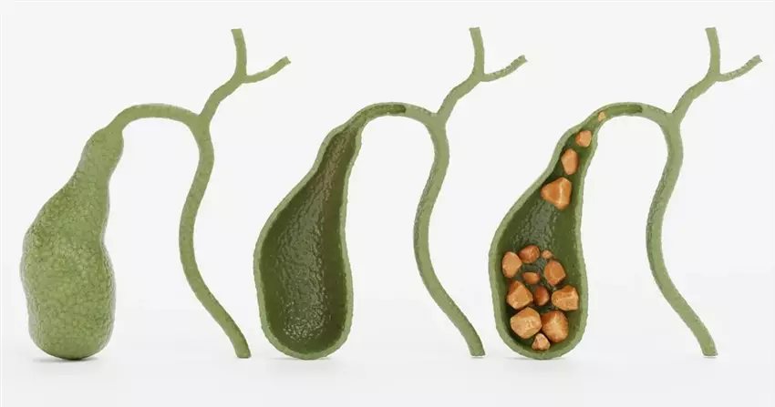 Чому в жовчному міхурі утворюються камені